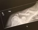 Filename : initial xray damage.jpg
Filesize : 12KB
Dimensions : 288x229
Date added : May 26, 2016 initial xray damage.jpg
