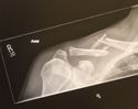 Filename : initial xray damage~0.jpg
Filesize : 13KB
Dimensions : 288x229
Date added : Apr 07, 2020 initial xray damage~0.jpg